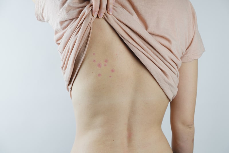 bed bug bites on woman's back