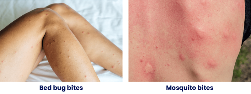 bed bug bites vs. mosquito bites